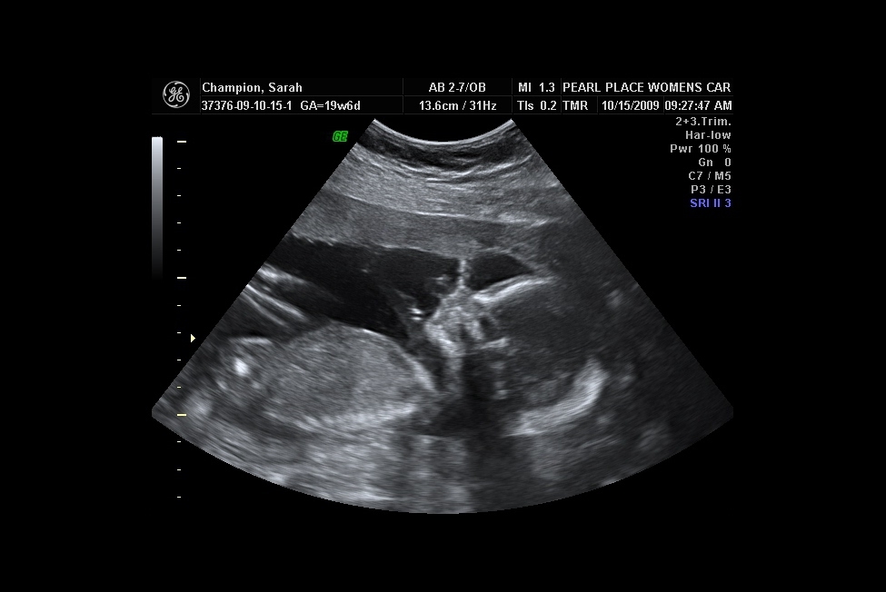 Ultra sound profile.